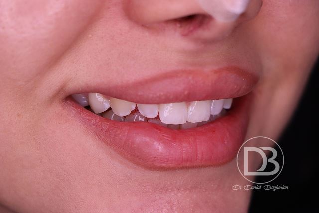 بهترین نوع لمینت چیست