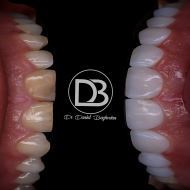 مراقبت های بعد از کامپوزیت