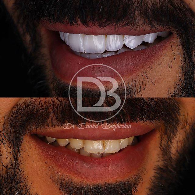 مراقبت های بعد از لمینت