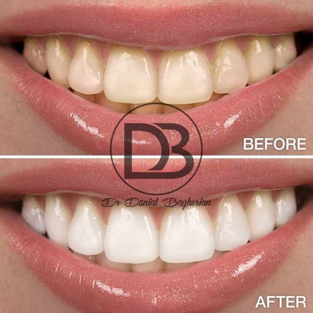 مراقبت های بعد از بلیچینگ