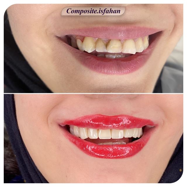 بهترین کامپوزیت دندان در اصفهان