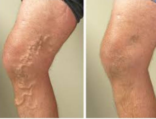 بیماری واریس چه علت ها و درمان هایی دارد؟