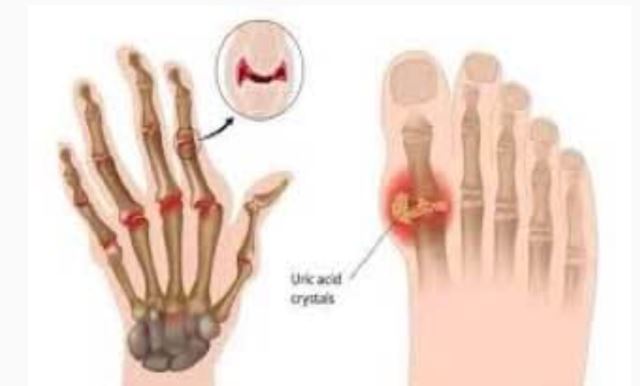 بیماری نقرس چه علت ها و درمان هایی دارد؟