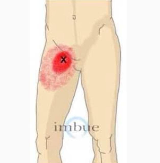 درد کشاله ران چه علت ها و درمان هایی دارد؟