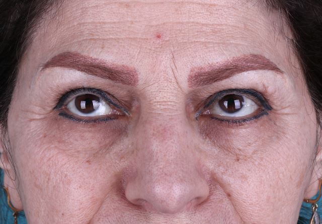 عکسهای پلک(بلفاروپلاستی)