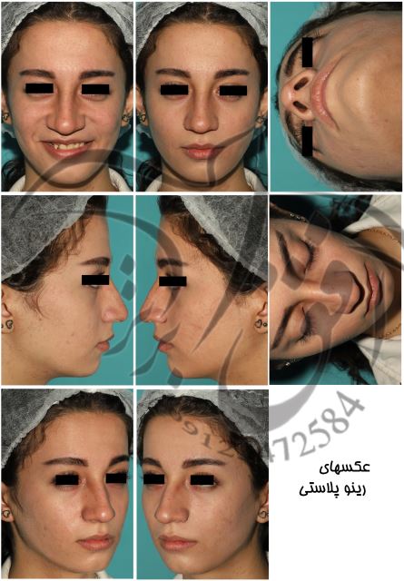 عکسهای عمل بینی