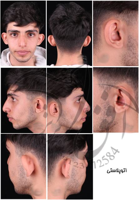 عکسهای عمل گوش (اتوپلاستی)