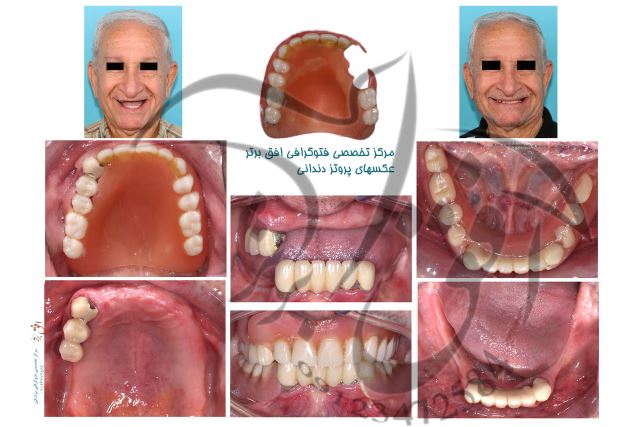 عکسهای پروتز دندانی دندان مصنوعی