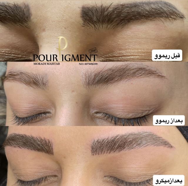 ریموو تتو و میکرو ابرو