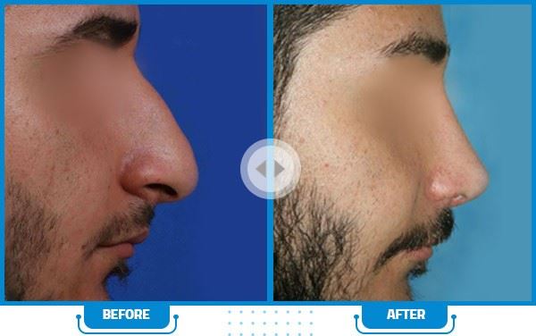 بهترین جراح بینی در شیراز