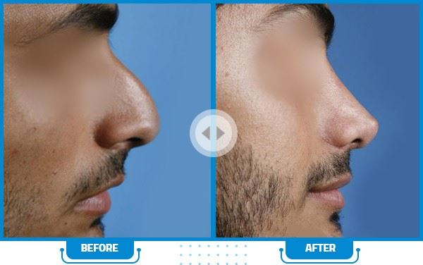 بهترین جراح بینی در شیراز