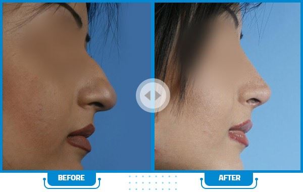 بهترین جراح بینی در شیراز