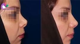 بهترین جراح بینی در شیراز