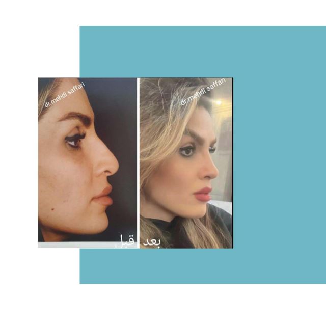 بهترین جراح بینی اصفهان
