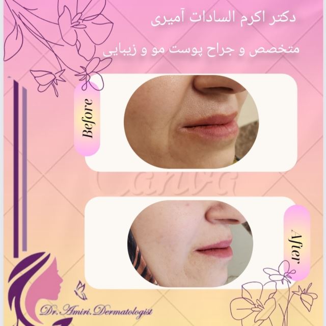 فیلر خط خنده