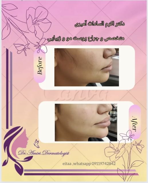 فیلر چانه