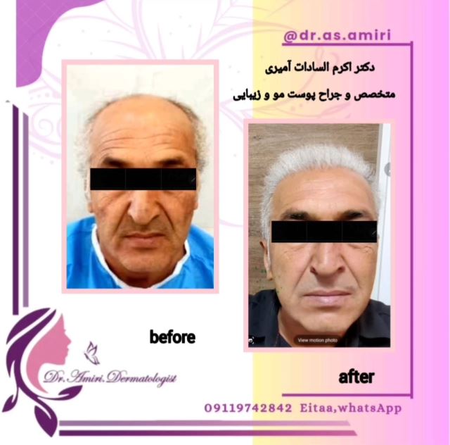 کاشت مو