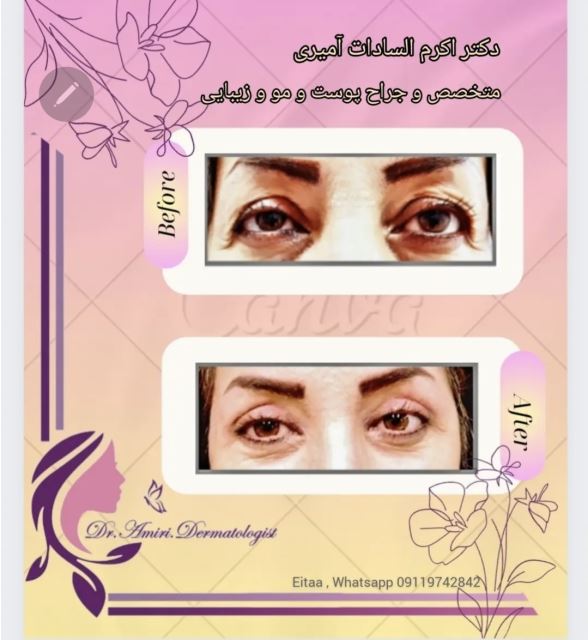 جراحی پلک