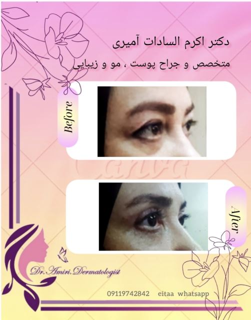 جراحی پلک