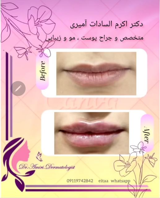 فیلر لب