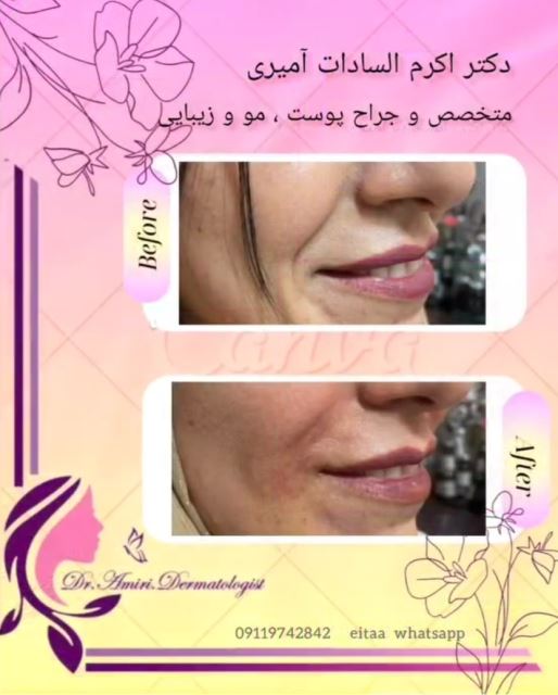 فیلر خط خنده