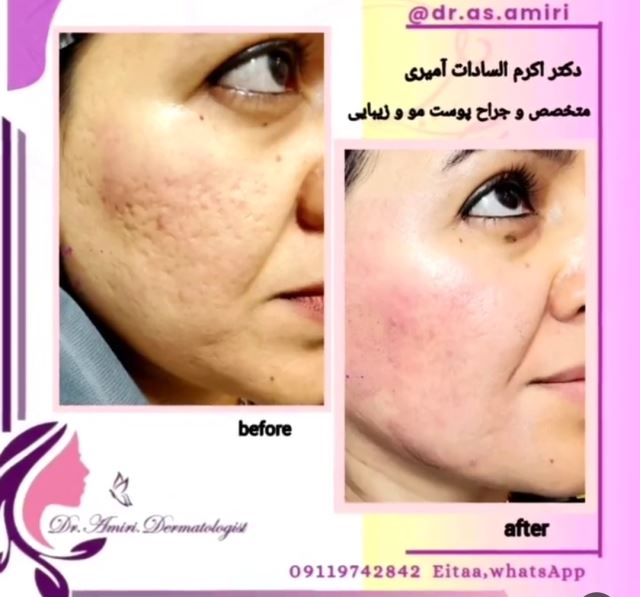 اسکار اکنه