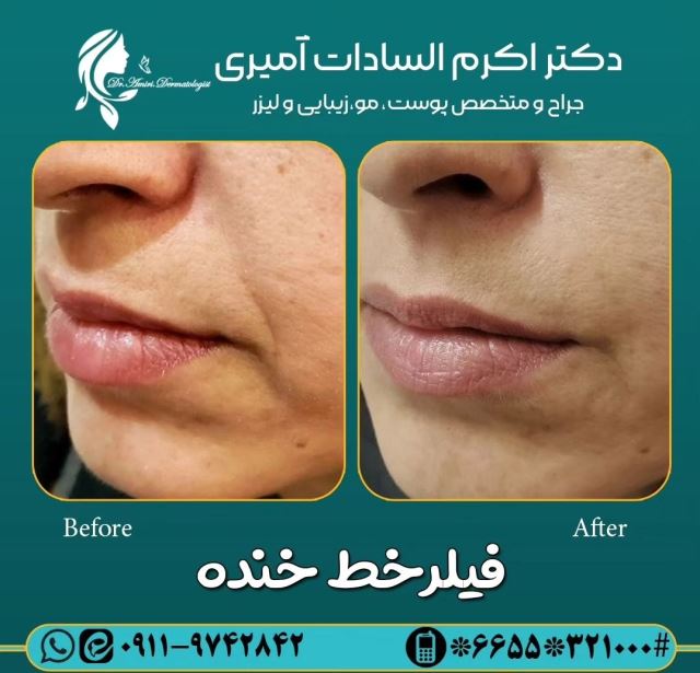 فیلر خط خنده