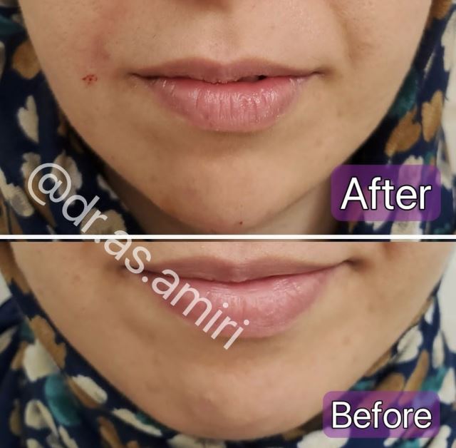 فیلر چانه
