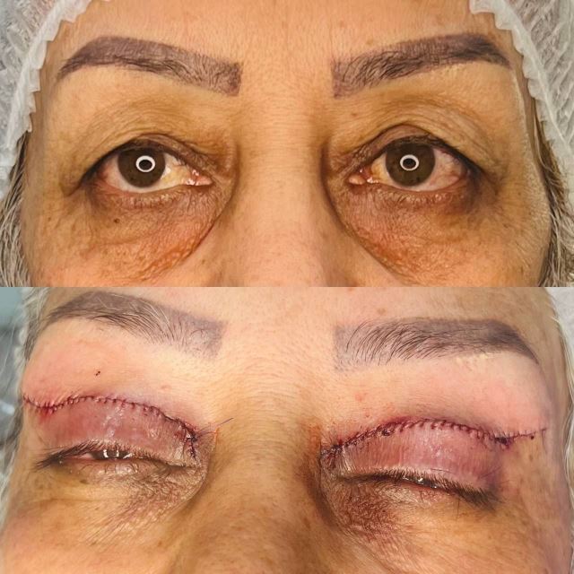 افتادگی پلک