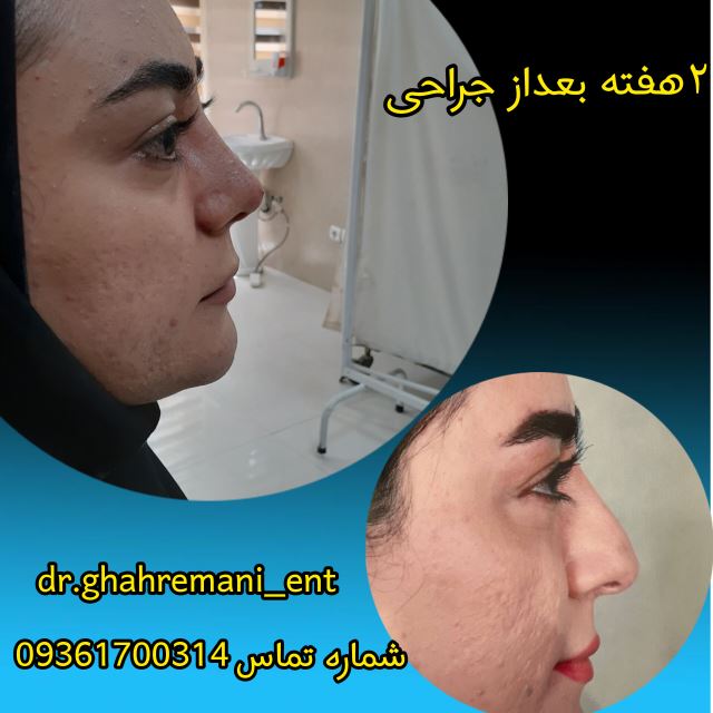 جراحی. بینی