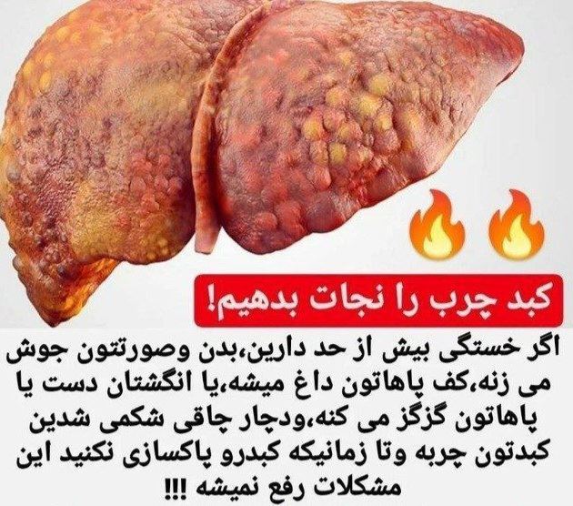 علائم بیماری کبد چرب 