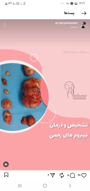 جراحی زنان فببروم