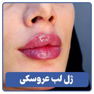 ژل لب عروسکی