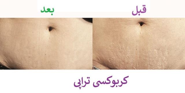 کربوکسی تراپی شکم