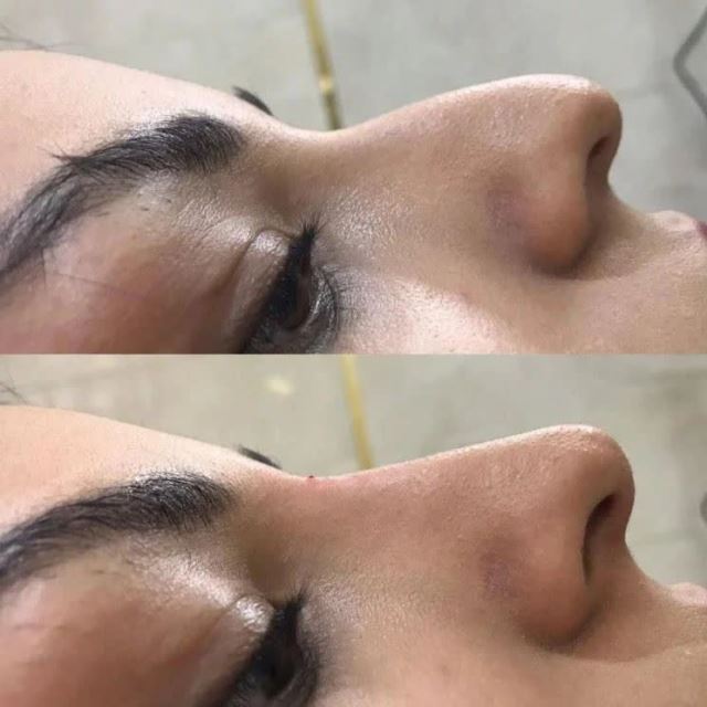  کربوکسی تراپی ابرو