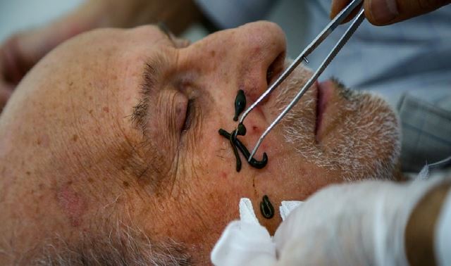 زالودرمانی