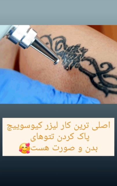 پاک کردن تتو قدیمی