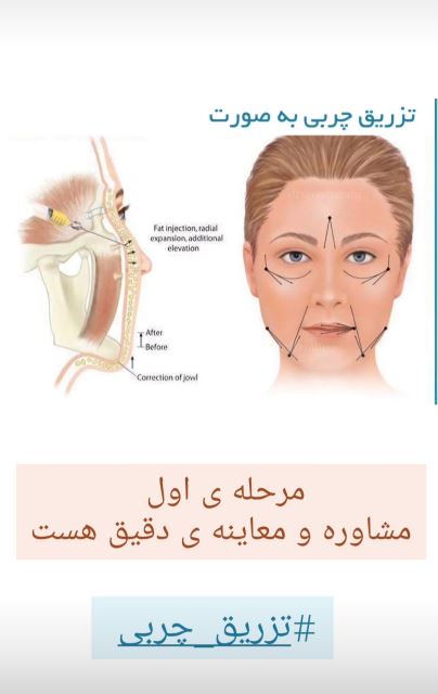 فرآیند تزریق چربی