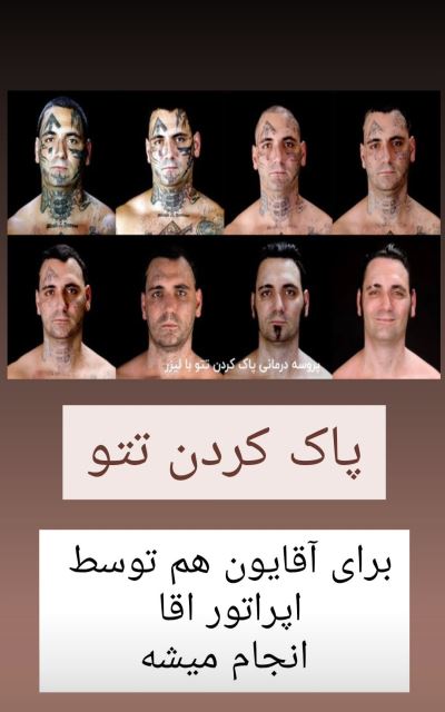 پاک کردن تتو قدیمی