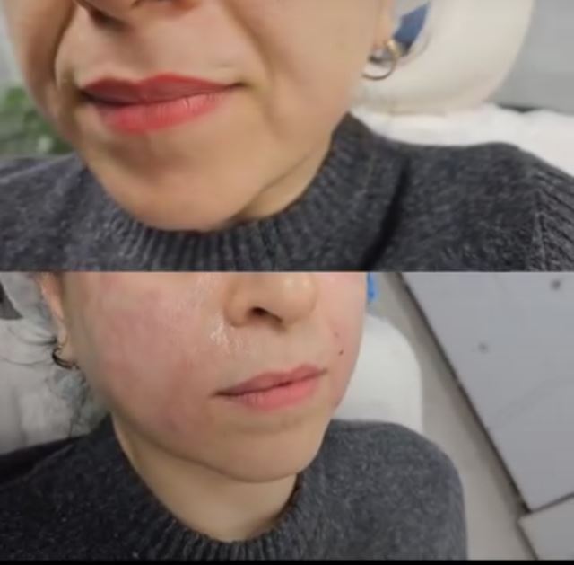 تزریق فیلر خط خنده