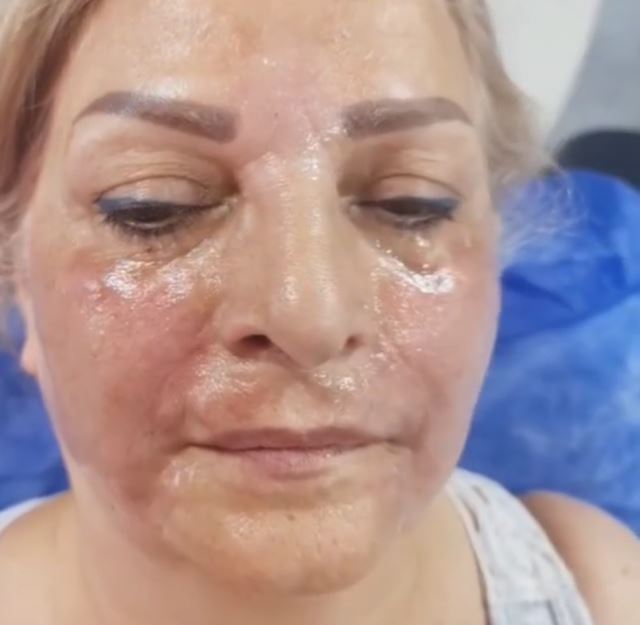 بعداز تزریق فیلر خط خنده