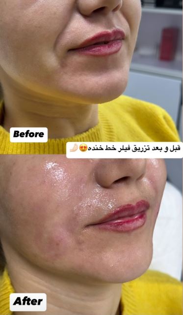 فیلر خط خنده