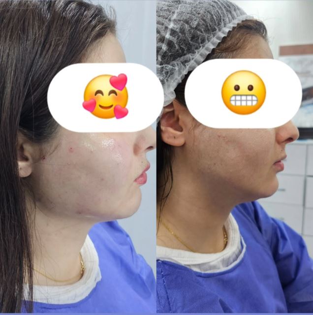 زاویه سازی صورت