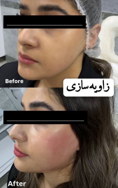 زاویه سازی فک