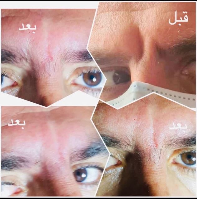 فیلر