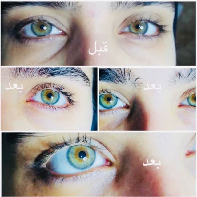 تزریق فیلر