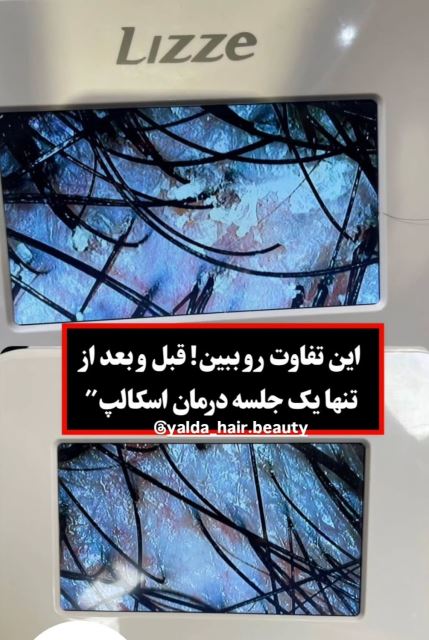 اسکراب اسکالپ