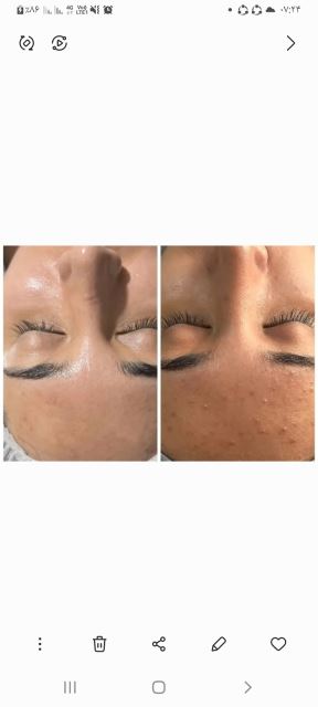 پوست چرب وجوشدار