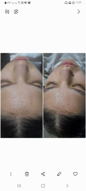 پوست چرب و جوشدار