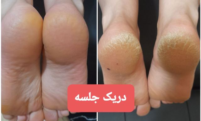 پکیج پاکسازی پا(پدیکور معمولی)